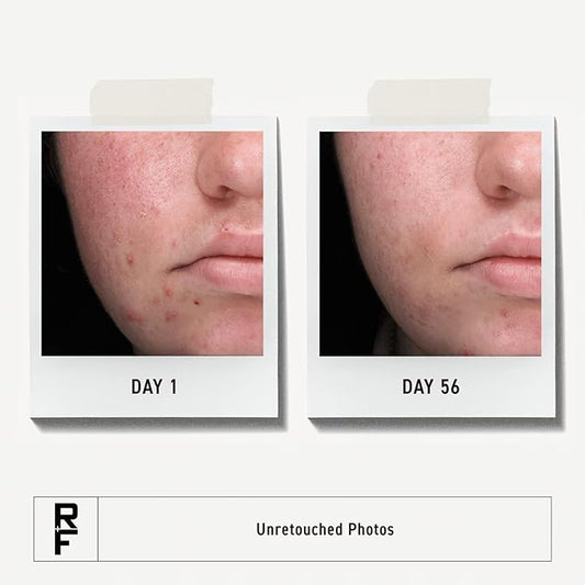 Rodan + Fields Spotless Regimen | Benzoyl Peroxide Face Wash for Sensitive Skin | Skincare Sets & Kits | Skin Care for Adults & Teens with Stubborn Acne | All Skin Types