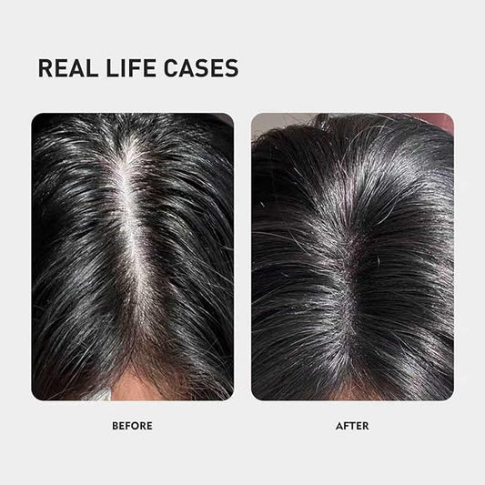 0.5% KX-826 DHT Blocker Hair Thickening Growth Products，Plant-Based Extract Essence Anti-Hair Loss Solution,Hair Spray,3 Days Oil Control 1-2 Weeks Hair Loss Reduction 3-6 Months New Hair Visible